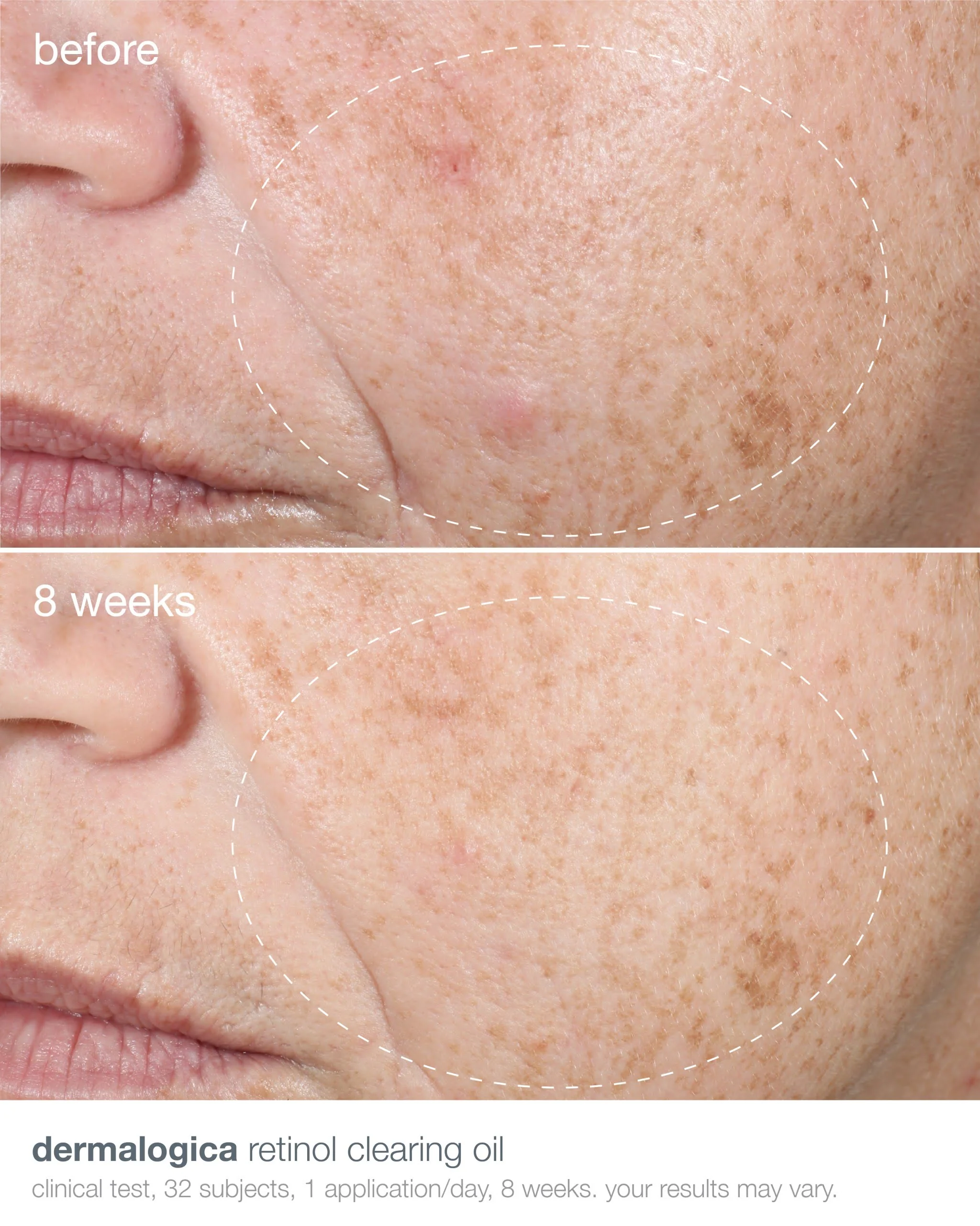 retinol acne clearing oil - Image 5